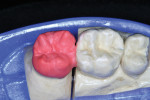 Figure 10   Buccal dentin porcelain was then added.