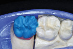 Figure 13  Occlusal/lingual porcelain was applied—maintaining morphology during the process.