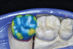 Figure 16  To optimize the results, translucent porcelain was applied around critical areas of the build-up.