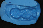 Figure 18  To create the full-contoured zirconia and pressed lithium disilicate crowns, the author took a putty matrix of the PFM crown.