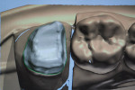 Figure 20  To create the layered zirconia-milled crown, the author used the same die and scanned it.