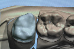 Figure 21  The clinical success of layered zirconia substructures requires following manufacturers’ commendations.