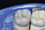 Figure 24  The final full-contour zirconia crown was stained and glazed.