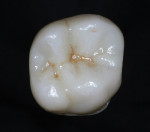 Figure 28  The scanned and milled full-contour zirconia crown.