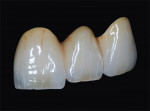 Figure 35  The ability to create natural-looking and functioning restorations is in the hands of the skilled and knowledgeable technician.