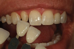 Figure 3  Incisal translucency, calcification, and surface texture was checked.