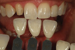 Figure 4  Incisal translucency, calcification, and surface texture was checked.