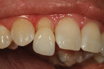 Figure 35  At the final appointment, the author checked to see if the veneer.compared to the adjacent teeth.