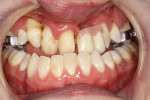 Figure 1  An orthodontic wire-retained prosthesis.