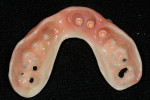 Figure 15  Acetal resin appliance with Equator housings was picked up in reline impression.