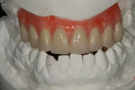 Figure 16  The waxed denture was prepared for the patient and doctor’s approval.