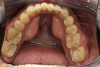 Fig 9. This image shows an example of vertical releasing incisions that are extended laterally across the mucogingival junction of adjacent teeth to attain better access and facilitate large graft procedures.

Fig 10. Case 2: Missing tooth No. 7 was extracted 3 months before implant placement.