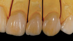 Figure 24  A right lateral view of the veneers.