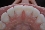 Figure 28  An occlusal view of the veneers at cementation.