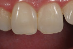 Figure 31  Shade A1 was used for the natural teeth.