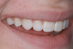 Figure 37  A right and left lateral view of the seated veneers.