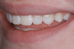 Figure 38  A right and left lateral view of the seated veneers.