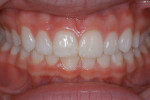 Figure 39  A retracted view of the seated veneers.