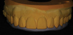 Figure 42  An incisal matrix was made on a model of the prototypes.