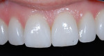 Figure 51  A close-up of the final veneers after cementation.