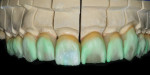 Figure 25  A blend from the gingival to the incisal was created using a combination of Opal 3 and Ti 1.