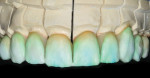 Figure 26  A blend from the gingival to the incisal was created using a combination of Opal 3 and Ti 1.