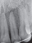 Figure 4  An X-ray of tooth No. 7 that had been re-implanted by the emergency room doctor after being avulsed.