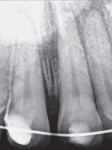 Figure 6  An X-ray of the formerly impacted tooth No. 10 and the surrounding broken bone.