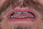 Figure 10  After composite build-up by the author’s general dentist, tooth display in repose was restored.