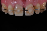 Figure 13  A cuspid-to-cuspid view of the stabilizing wire and the direct composite restorations.