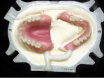 Figure 4  The Palajet system offers the ability to flask two dentures at the same time, in contrast to the conventional labor-intensive method of one denture at a time. This not only saves time, but also adds consistency to the entire process.