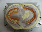 Figure 6  The application of the gingival colors prior to the injection.