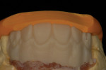Figure 9: PMMa material was injected to duplicate an exact replica of the wax-up.Fig 9. An incisal index provided a reference for the cutback.