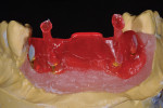 Figure 19  Resin was injected again to form the implant bar that was invested and cast. Alternately, the resin bar could be scanned or CAD designed for CAM milling.
