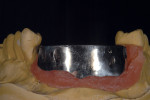 Figure 20  Resin was injected again to form the implant bar that was invested and cast. Alternately, the resin bar could be scanned or CAD designed for CAM milling.