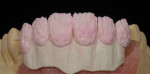 Figure 27  The dentin buildup was completed. Then pink ceramic base shade materials were used for the cervical, and mamelons effects were layered in.