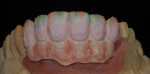 Figure 28  The dentin buildup was completed. Then pink ceramic base shade materials were used for the cervical, and mamelons effects were layered in.