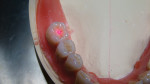 Figure 17  The Statik Laser (Candulor) was used to ensure accurate positioning of the central fossa of the first mandibular molar directly over the lowest point on the residual ridge.