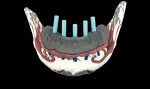 Figure 4  A fully edentulous case that is being planned using CT-guided all-on-five implants.