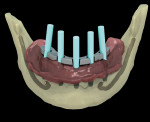 Figure 5  A CT-guided all-on-five implant case with long-term provisional.