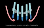 Figure 6  Implant positioning in relation to long-term provisional bar.
