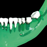 Figure 7  Implant planning incorporating three zirconia nSequence Wave abutments.