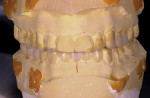 Figure 1  A conventional diagnostic mock-up from the dentist with wax added and stone removed to create ideal tooth arrangement.