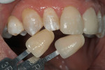 Figure 1  The original prescription submitted by the restoring dentist involved only tooth No. 9, which presented with a problematic debonding veneer. The tooth was prepared and photographs were sent to the laboratory via e-mail for evaluation.