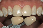 Figure 2  The case called for matching a single central incisor to a pre-fabricated restoration.