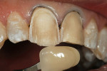 Figure 4  Refractory casts were fabricated to support the ceramic refractory veneers.