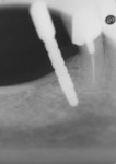 Figure 3  A guide pin with radiographic markings is used during osteotomy preparation as a means of determining depth and position of the implant after an inferior local alveolar block injection was used.