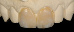 Figure 8  White stains mixed with a white enamel were used in the build-up to create the calcified look of the patient’s natural teeth.