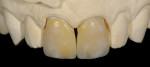 Figure 9  Veneers were de-vested and fit to the original dies with yellow die spacer and then checked on a solid cast.