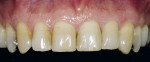 Figure 2  The patient presented with a restoration that was nearly 30 years old. The patient’s ideal was an esthetic, unnoticeable, and metal-free restoration.
